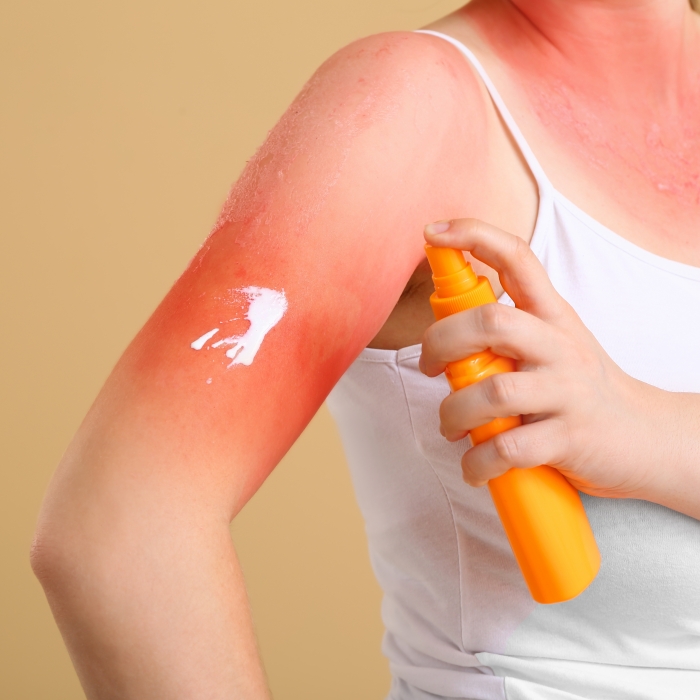 Seguros bajo el sol: ¡Conoce cómo cuidar tu piel!